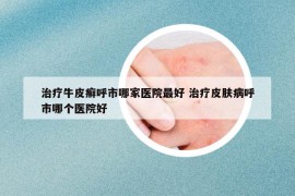 治疗牛皮癣呼市哪家医院最好 治疗皮肤病呼市哪个医院好