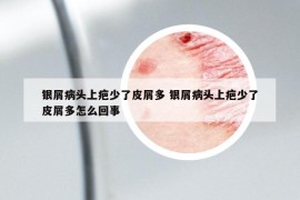 银屑病头上疤少了皮屑多 银屑病头上疤少了皮屑多怎么回事