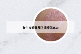 有牛皮癣又涨了湿疹怎么办