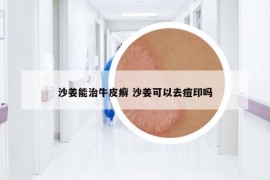 沙姜能治牛皮癣 沙姜可以去痘印吗