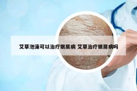 艾草泡澡可以治疗银屑病 艾草治疗银屑病吗