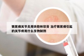 银屑病关节炎用扶他林软膏 治疗银屑病引起的关节疼用什么生物制剂