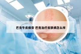 巴克牛皮癣膏 巴克治疗皮肤病怎么样