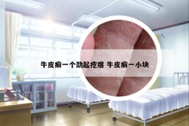 牛皮癣一个劲起疙瘩 牛皮癣一小块