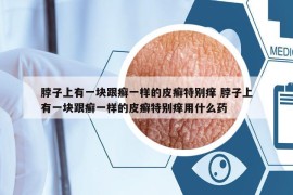 脖子上有一块跟癣一样的皮癣特别痒 脖子上有一块跟癣一样的皮癣特别痒用什么药