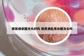 银屑病拿醋洗头好吗 银屑病能用白醋洗头吗