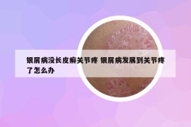 银屑病没长皮癣关节疼 银屑病发展到关节疼了怎么办