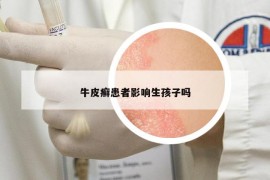 牛皮癣患者影响生孩子吗
