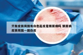 只有皮损周围有白色起皮是银屑病吗 银屑病皮损周围一圈白皮