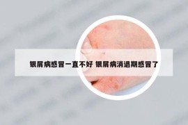 银屑病感冒一直不好 银屑病消退期感冒了