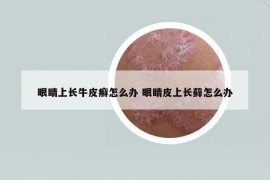 眼睛上长牛皮癣怎么办 眼睛皮上长藓怎么办