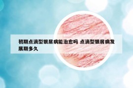 初期点滴型银屑病能治愈吗 点滴型银屑病发展期多久