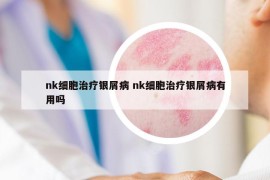 nk细胞治疗银屑病 nk细胞治疗银屑病有用吗