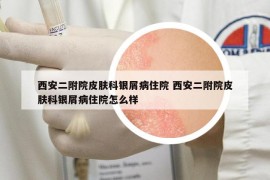 西安二附院皮肤科银屑病住院 西安二附院皮肤科银屑病住院怎么样