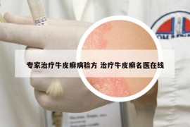 专家治疗牛皮癣病验方 治疗牛皮癣名医在线