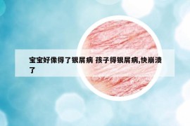 宝宝好像得了银屑病 孩子得银屑病,快崩溃了
