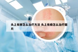 头上有鲜怎么治疗方法 头上有癣怎么治疗图片