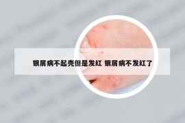 银屑病不起壳但是发红 银屑病不发红了