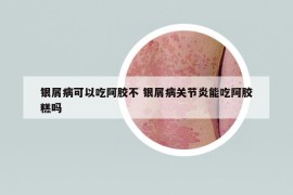 银屑病可以吃阿胶不 银屑病关节炎能吃阿胶糕吗