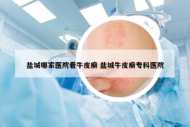 盐城哪家医院看牛皮癣 盐城牛皮癣专科医院
