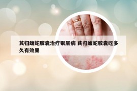 芪归蝮蛇胶囊治疗银屑病 芪归蝮蛇胶囊吃多久有效果