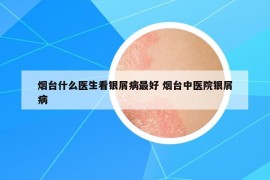 烟台什么医生看银屑病最好 烟台中医院银屑病