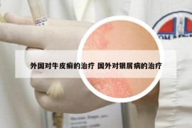 外国对牛皮癣的治疗 国外对银屑病的治疗