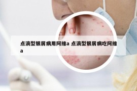 点滴型银屑病用阿维a 点滴型银屑病吃阿维a