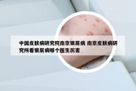 中国皮肤病研究院南京银屑病 南京皮肤病研究所看银屑病哪个医生厉害