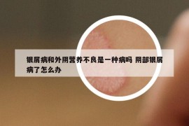 银屑病和外阴营养不良是一种病吗 阴部银屑病了怎么办