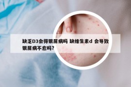 缺乏D3会得银屑病吗 缺维生素d 会导致银屑病不愈吗?