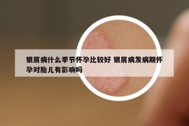 银屑病什么季节怀孕比较好 银屑病发病期怀孕对胎儿有影响吗