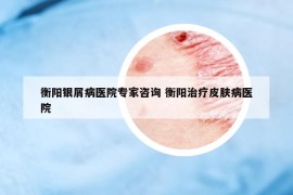 衡阳银屑病医院专家咨询 衡阳治疗皮肤病医院