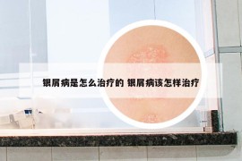 银屑病是怎么治疗的 银屑病该怎样治疗