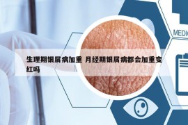 生理期银屑病加重 月经期银屑病都会加重变红吗