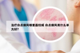 治疗白点癫风哪里最权威 白点癫风用什么单方好?