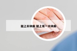 腿上长块癣 腿上有一大块癣