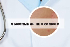牛皮癣贴足贴有用吗 治疗牛皮银屑癣药贴