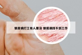 银屑病打工有人要没 银屑病找不到工作