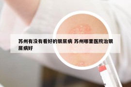 苏州有没有看好的银屑病 苏州哪里医院治银屑病好