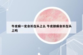 牛皮癣一定会长在头上么 牛皮肤癣会长在头上吗
