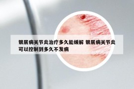 银屑病关节炎治疗多久能缓解 银屑病关节炎可以控制到多久不发病