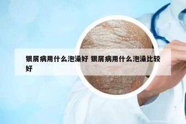 银屑病用什么泡澡好 银屑病用什么泡澡比较好