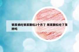 银屑病吃银屑颗粒2个月了 银屑颗粒吃了发胖吗