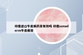 印度进口牛皮癣药膏有效吗 印度sonaderm牛皮癣膏