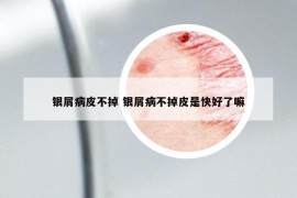 银屑病皮不掉 银屑病不掉皮是快好了嘛