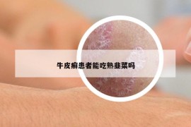 牛皮癣患者能吃熟韭菜吗