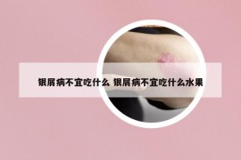 银屑病不宜吃什么 银屑病不宜吃什么水果