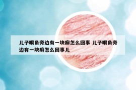 儿子眼角旁边有一块癣怎么回事 儿子眼角旁边有一块癣怎么回事儿