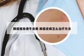 脚底板有像牛皮癣 脚底皮癣怎么治疗方法